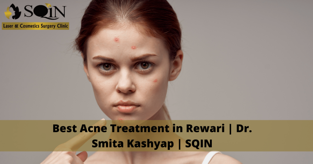 Best Acne Treatment in Rewari | Dr. Smita Kashyap | SQIN