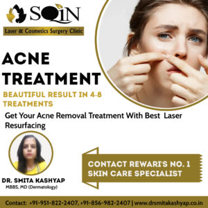 Acne Treatment in Rewari