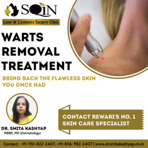 Warts Removal Treatment in Rewari